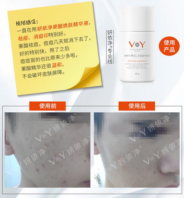 蜂胶果酸焕肤净痘精华液,全家一起用的护肤品