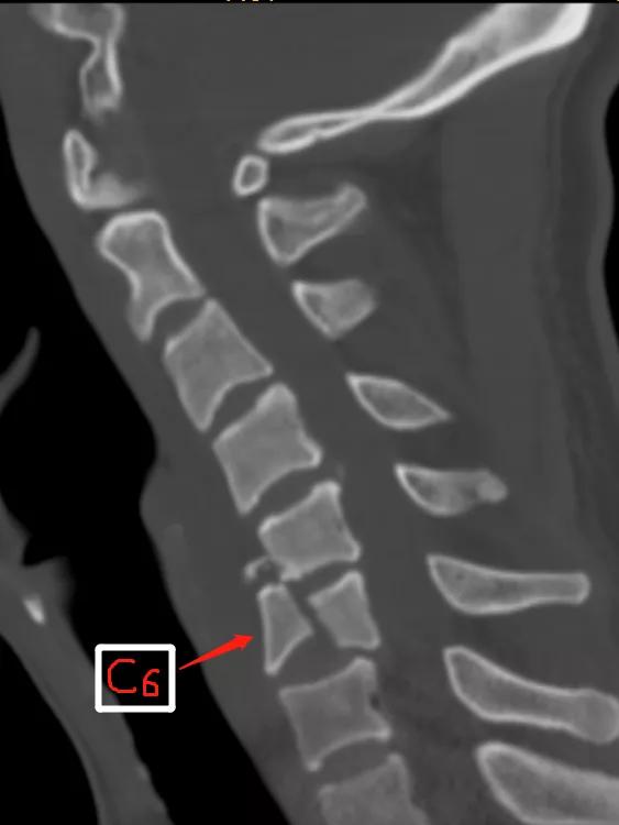 车祸颈椎骨折脱位会不会有后遗症,车祸导致颈椎错位手术风险大吗