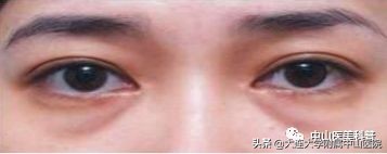 你有没有被自己的眼袋困扰过,关于眼袋的科普在这里