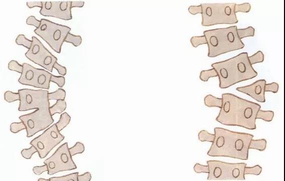 孩子发现脊柱侧弯该怎么办,十七岁女孩发现脊柱侧弯怎么办