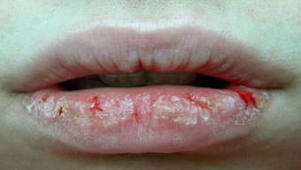 嘴唇干裂头皮屑多吃什么维生素,头皮屑太多吃什么维生素