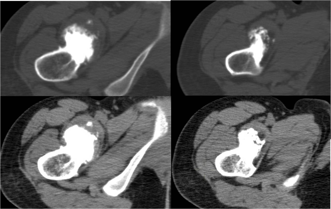 脊膜膨出与脊膜脊髓膨出,先天性脊髓脊膜膨出怎么治疗
