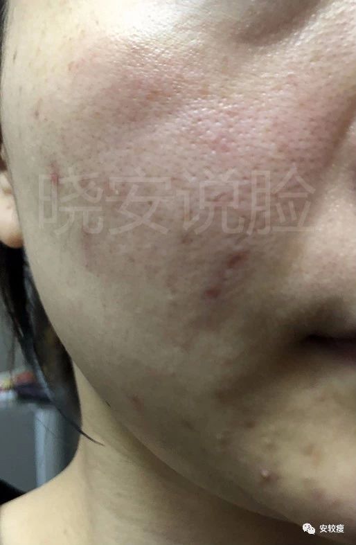 外油内干敏感痘肌怎么护肤,30岁油皮痘痘敏感肌怎么改善