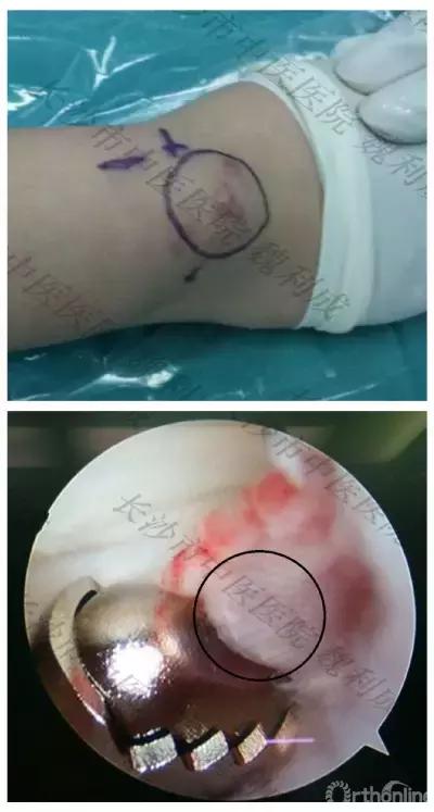 腱鞘囊肿除了手术还有什么办法,下颚有囊肿可以做穿刺手术