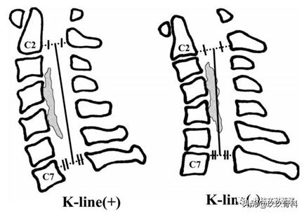 acaf手术适应脊髓型颈椎病吗,acaf术后康复方法
