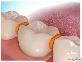 2020牙齿矫正攻略请查收,今日头条修复牙齿