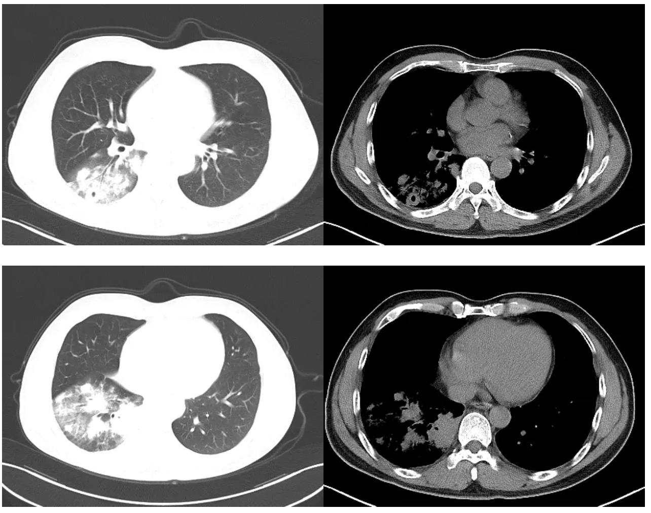 肺炎治疗7天症状好转ct无好转,肺炎治快二个月还没好