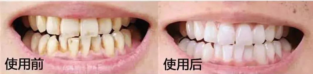 一张嘴就闻到牙臭味怎么办,一张嘴就恶臭怎么回事