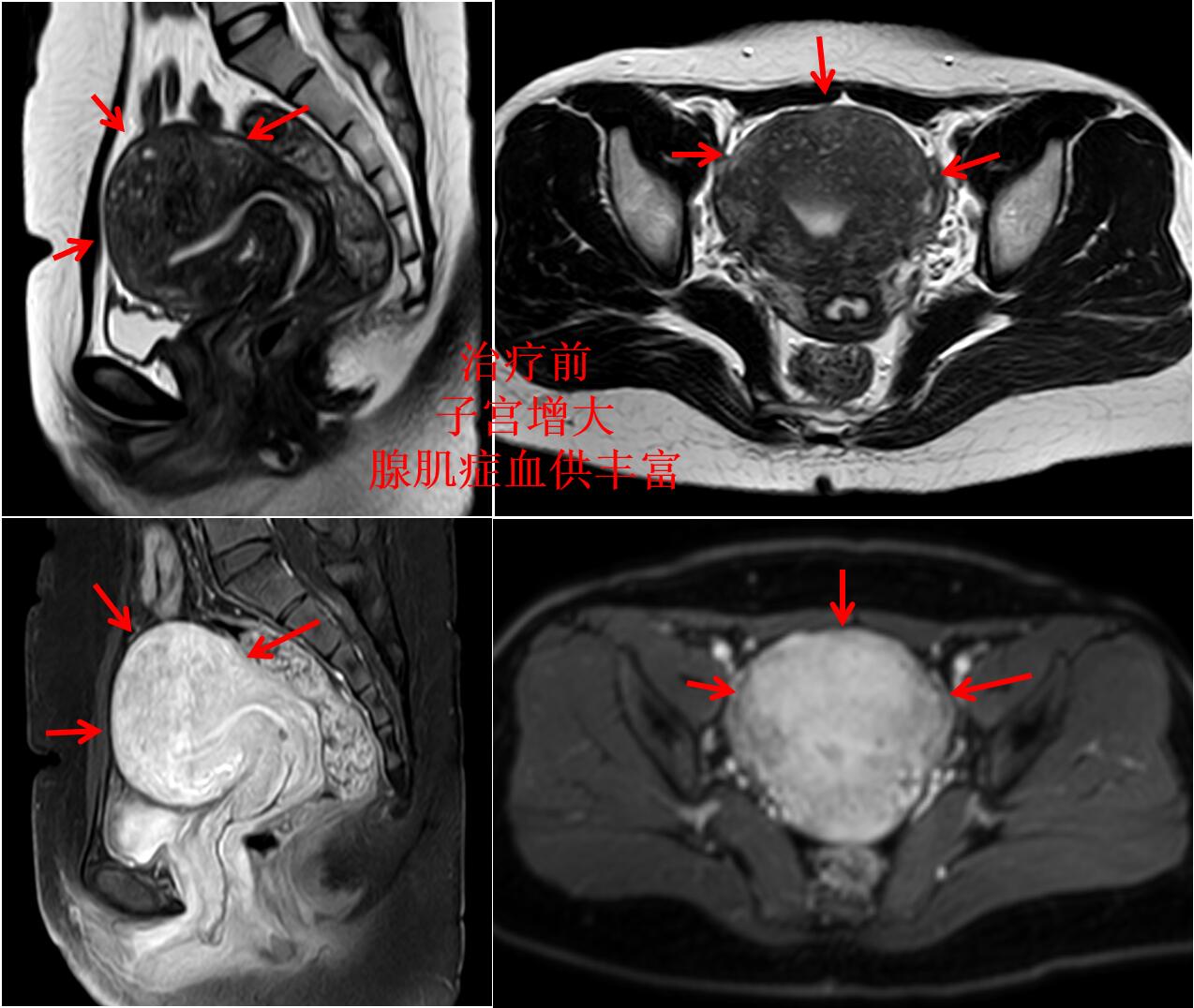 看看痛不欲生的子宫腺肌症痛经专业领域的看法与典型病例