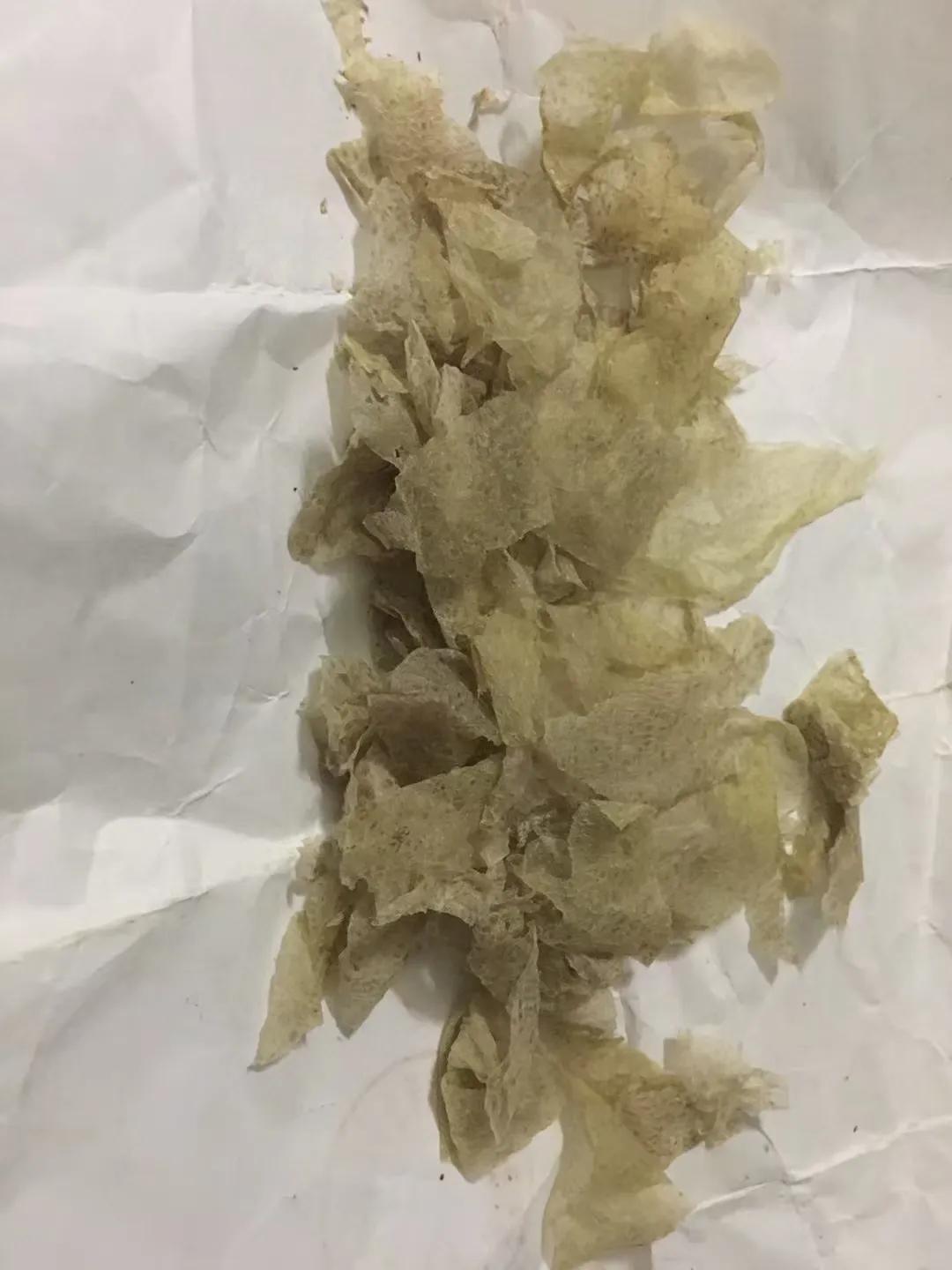 骨折人情冷暖,骨折后明白了人间冷暖