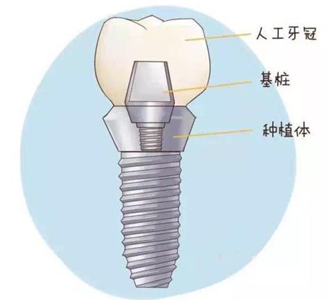 做种植牙要一直张嘴吗,做种植牙需要磨牙吗