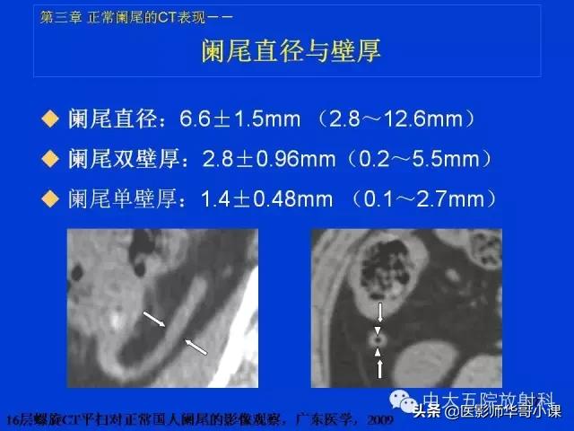 阑尾炎课件,阑尾炎的超声课件