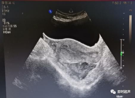 宫外孕的烦恼,你经历过宫外孕吗