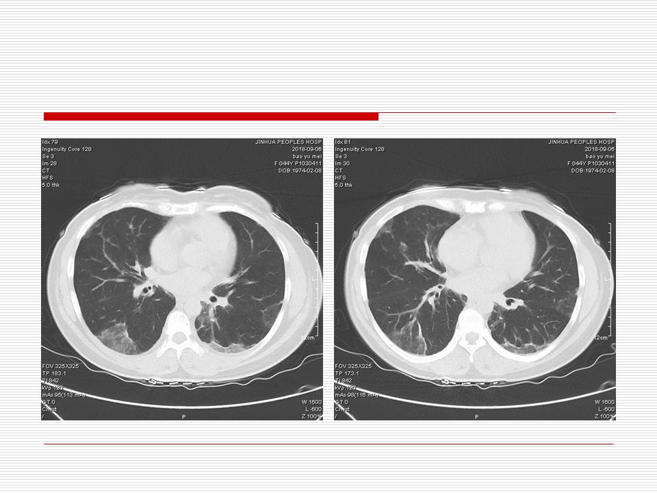 像炎症的肺癌能治好吗,医生说可能是肺癌也可能是炎症