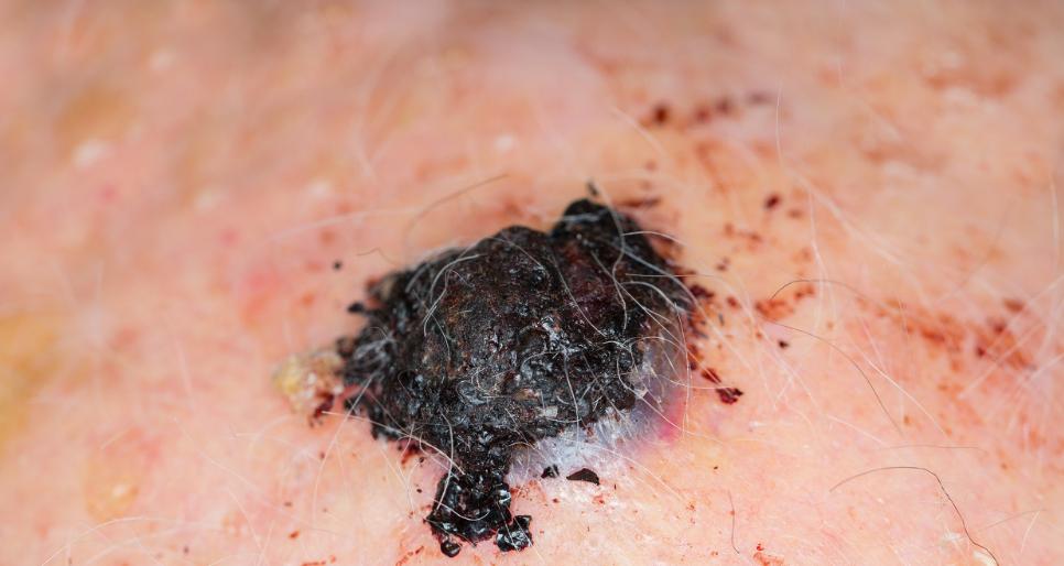 痣恶变前的3个征兆,痣的恶变会有征兆吗