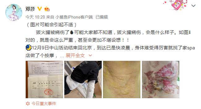 拔火罐被烧伤的明星,拔火罐明星烧伤