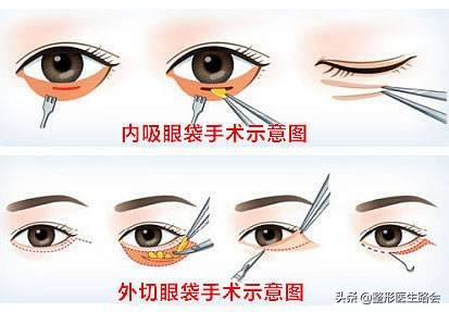 泪沟都到脸颊了怎么办,泪沟眼袋越来越严重怎么办