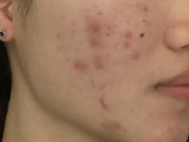 青春期月经逐渐规律的过程中长痘,青春期的痘痘来月经后会消失吗