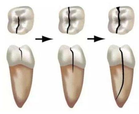 什么原因导致牙隐裂,牙隐裂的防治