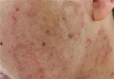 夏日如何远离体癣、花斑癣、股癣等各种皮肤癣的困扰