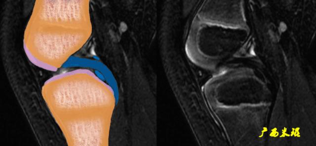 交叉韧带损伤的mr表现,后交叉韧带损伤的诊断实验