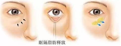 教你永久消除眼袋,眼袋对抗锻炼法