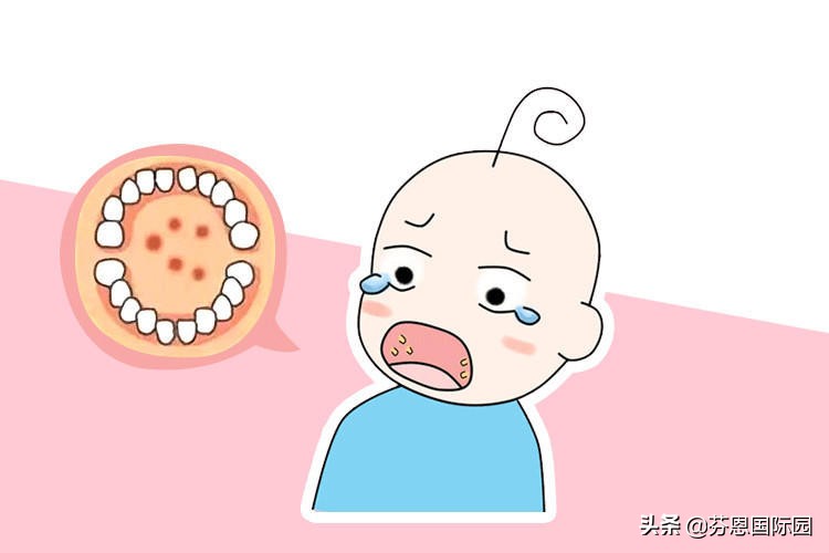 手足口诺如病毒,诺如病毒手足口高发