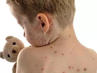 宝宝浑身长疹子，竟然是衣物惹的祸！买买买前先看看这篇选购指南