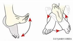 新冠感染怎样防静脉血栓,如何预防新冠引起的肺栓塞