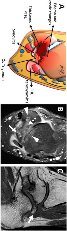 伸直后腿筋疼是怎么回事,前脚踝撞击综合征怎么治疗