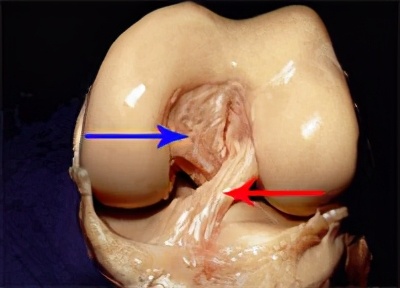 前交叉韧带损伤核磁共振,前后交叉韧带损伤的治疗