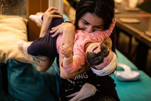 女婴脸上有胎记做了手术恢复了,女婴面部黑色胎记像蝙蝠侠面罩