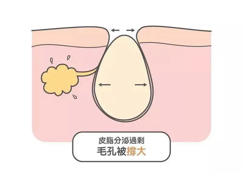 鼻头毛孔粗大如何改善缩小毛孔,皮肤毛孔粗大出汗可以缩小毛孔吗