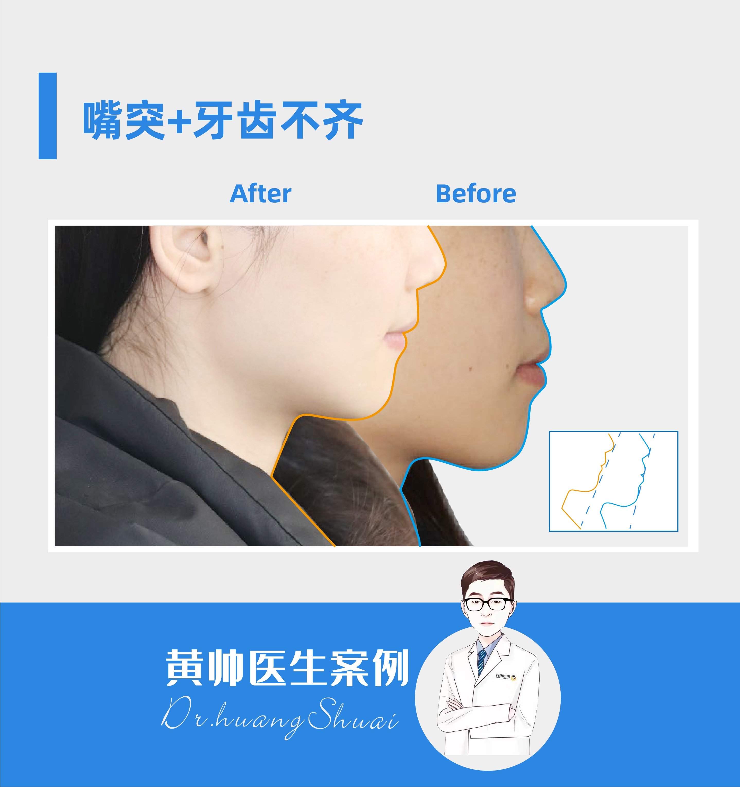 嘴凸牙齿矫正前后对比视频,牙齿矫正拔智齿可以怎样改善嘴凸