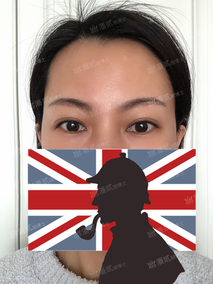 原来双眼皮不好看有必要继续割吗,割双眼皮是不是越修复越难看