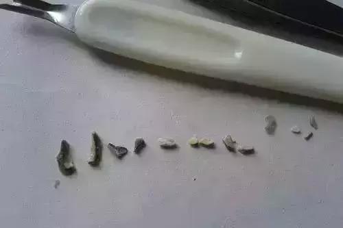 用手抠牙结石有什么不良影响,用手抠下一块牙结石
