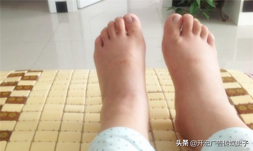 孕期怎么判断脸是肿还是胖,孕期脸浮肿生了后会瘦吗