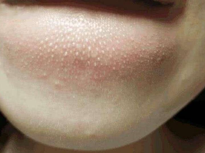 下巴处长很多小颗粒是怎么回事,下巴小颗粒一抠一个洞