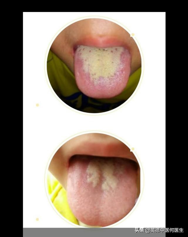 小孩反复发热扁桃体发炎,小孩积食引起扁桃体发炎怎么办