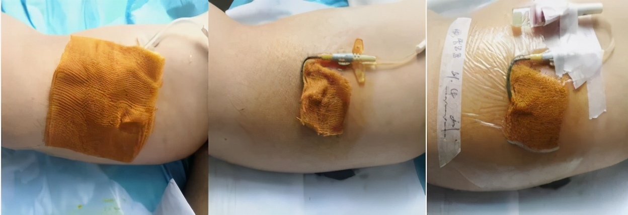 碘伏治疗PICC导管穿刺点感染的体会