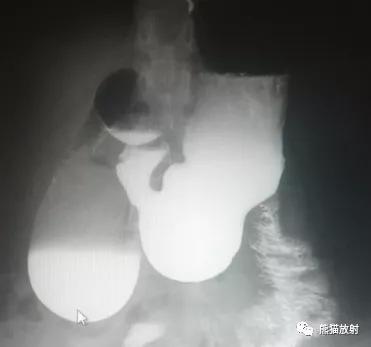 十二指肠球部溃疡解剖位置,十二指肠球部溃疡x线表现