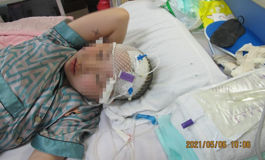 儿童脑出血昏迷三天后恢复正常了,脑出血后脑积水多久会出现症状