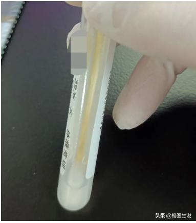 滴虫性阴道炎和霉菌性症状区别,滴虫性阴道炎与假丝酵母菌的区别