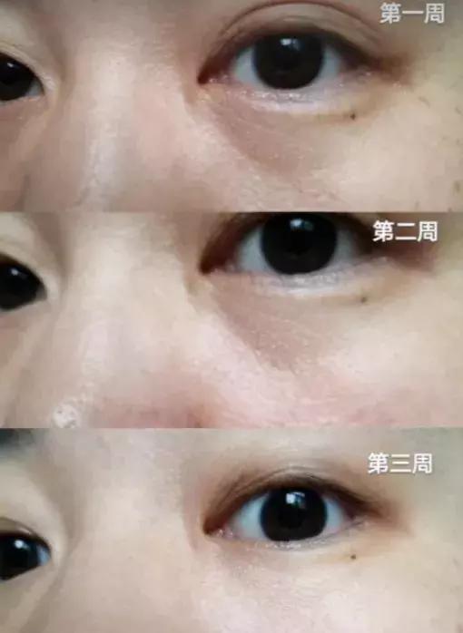 对眼纹有效果的眼霜推荐女生,年纪轻轻眼睛周围长细纹