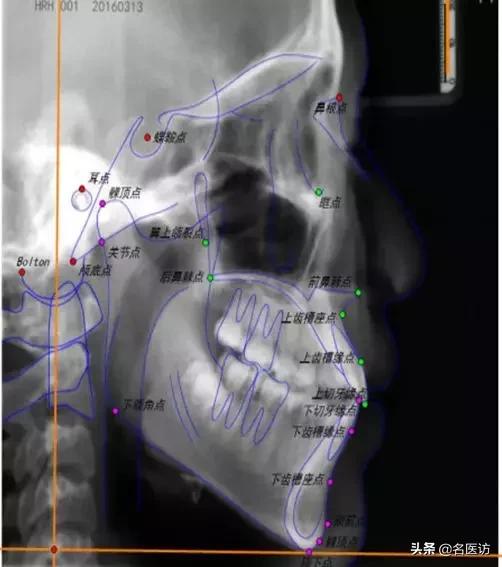 矫正科普|美人在骨不在皮，从神秘的牙片看牙齿和侧貌颜值
