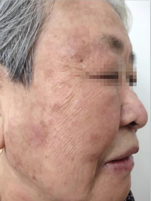 白癜风的正确看法,突然间长白癜风怎么回事