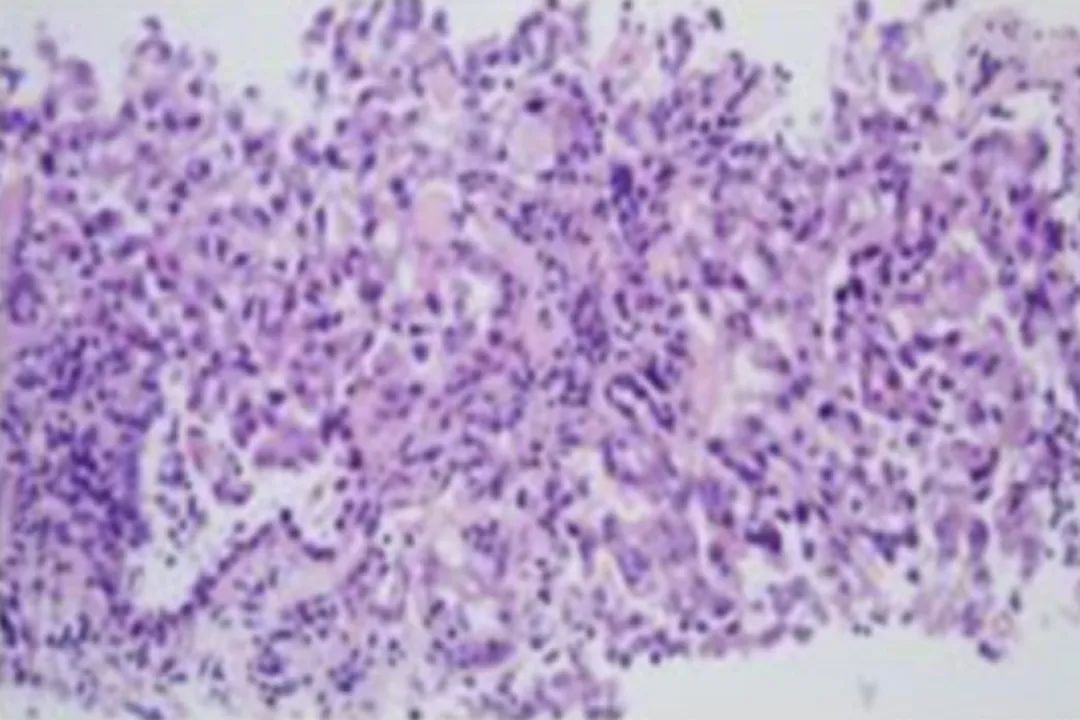 时隔一年再次住院,时隔一年旧病复发