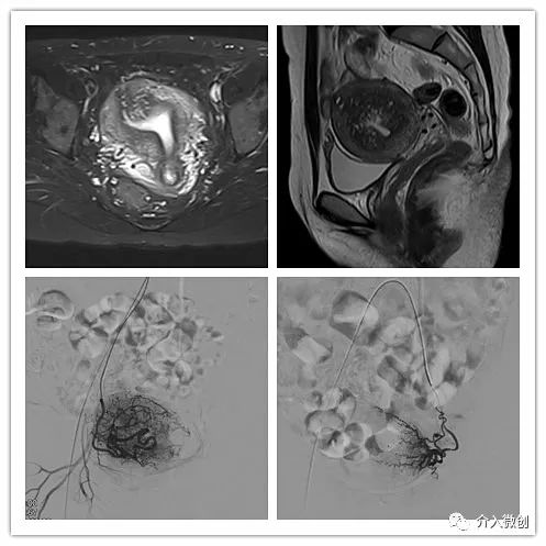 介入治疗腺肌病效果好吗,介入微创治疗子宫腺肌病是什么