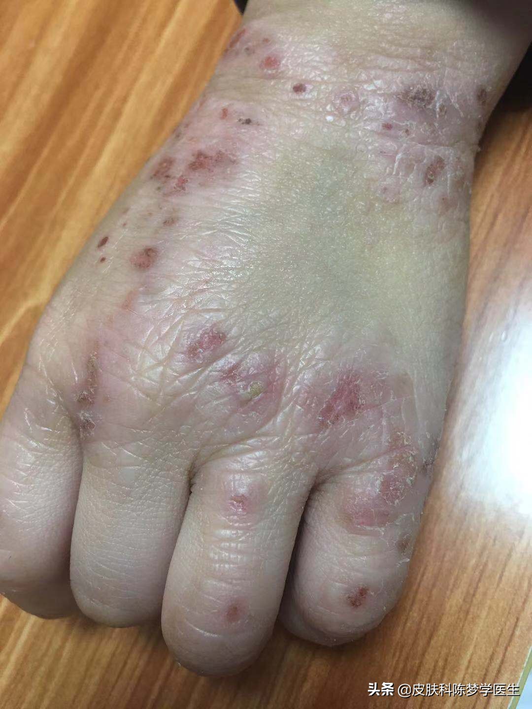 硫磺软膏能不能治湿疹,除湿止痒软膏能不能治湿疹