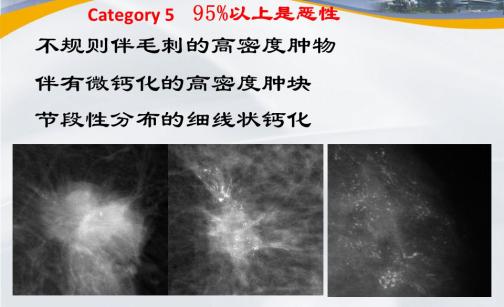 乳腺结节bi-rads分级依据,国内乳腺结节bi-rads分级标准